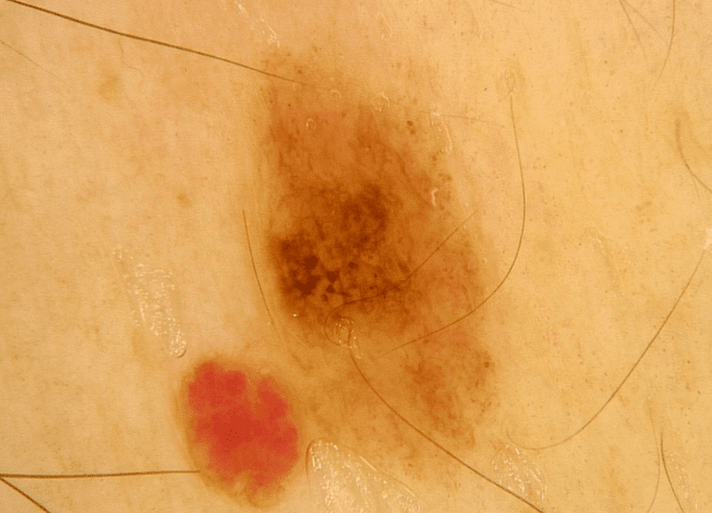 Wideodermatoskopia - zmapowane znamię nr 35. Wideodermatoskopia - zmapowane znamię nr 35.