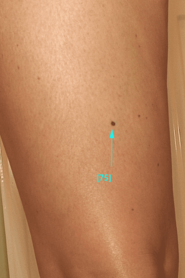 brzydkie kaczątko - znamię dysplastyczne brzydkie kaczątko - znamię dysplastyczne