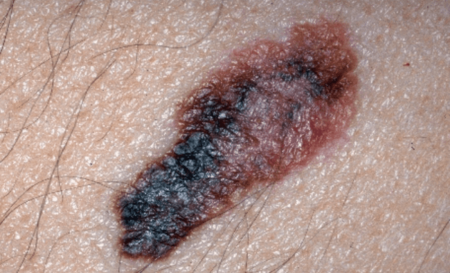 Czerniak złośliwy - melanoma zdjęcie kliniczne nowotwór barwnikowy Czerniak złośliwy - melanoma zdjęcie kliniczne nowotwór barwnikowy