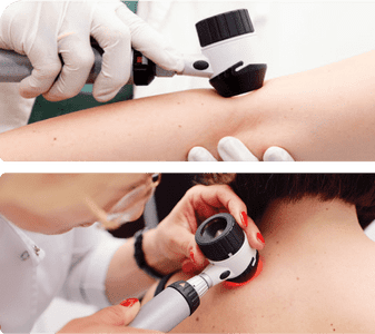Dermatoskopia znamion i pieprzyków