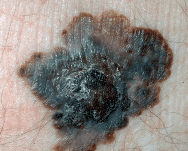 Czerniak złośliwy - melanoma zaawansowany nowotwór skóry zdjęcie dermatologiczne Czerniak złośliwy - melanoma zaawansowany nowotwór skóry zdjęcie dermatologiczne
