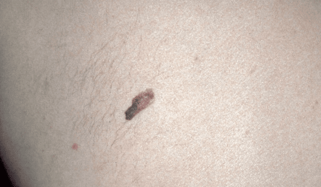 Czerniak złośliwy - melanoma zdjęcie medyczne niebezpieczny nowotwór skóry Czerniak złośliwy - melanoma zdjęcie medyczne niebezpieczny nowotwór skóry