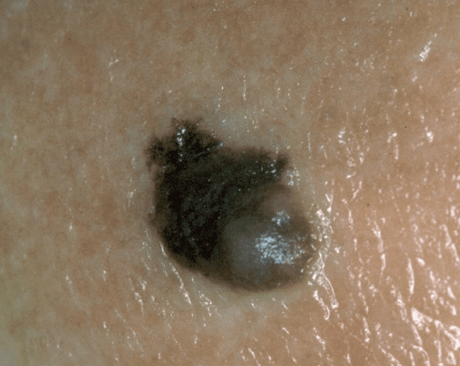 Czerniak złośliwy - melanoma przypomina podrażnioną brodawkę łojotokową zdjęcie Czerniak złośliwy - melanoma przypomina podrażnioną brodawkę łojotokową zdjęcie