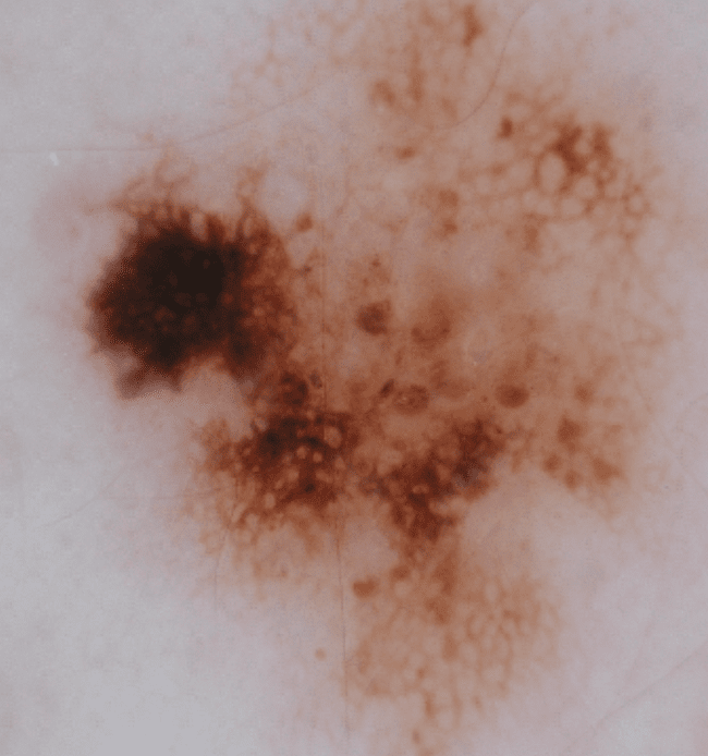 Czerniak złośliwy - melanoma zdjęcie medyczne złośliwy nowotwór Czerniak złośliwy - melanoma zdjęcie medyczne złośliwy nowotwór
