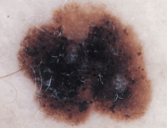 Czerniak złośliwy - melanoma różnorodność barw ABCDE zdjęcie kliniczne Czerniak złośliwy - melanoma różnorodność barw ABCDE zdjęcie kliniczne
