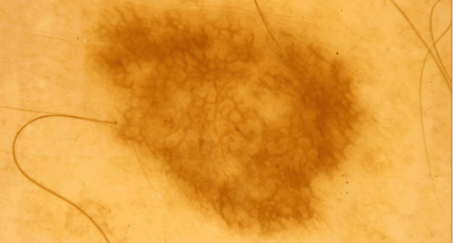 Zwykłe znamię barwnikowe - pieprzyk łagodny zdjęcie dermatologiczne Zwykłe znamię barwnikowe - pieprzyk łagodny zdjęcie dermatologiczne