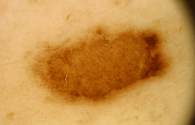 Wideodermatoskopia - zmapowane znamię nr 22. Wideodermatoskopia - zmapowane znamię nr 22.