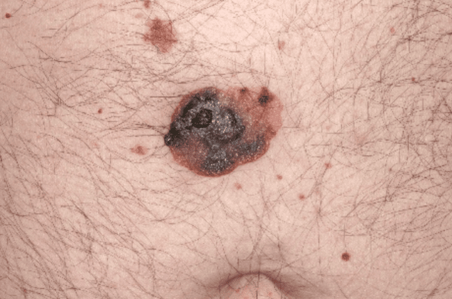 Czerniak złośliwy - melanoma zaawansowane stadium wrzodzenie zdjęcie medyczne Czerniak złośliwy - melanoma zaawansowane stadium wrzodzenie zdjęcie medyczne