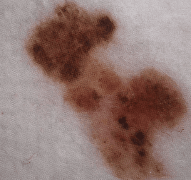 Czerniak złośliwy - melanoma objawy ABCDE zdjęcie medyczne przykład Czerniak złośliwy - melanoma objawy ABCDE zdjęcie medyczne przykład