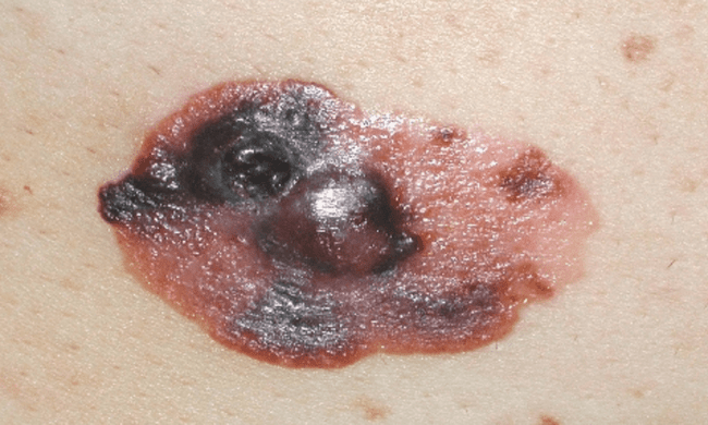 Czerniak złośliwy - melanoma zaawansowany czerniak krwawienie zdjęcie kliniczne Czerniak złośliwy - melanoma zaawansowany czerniak krwawienie zdjęcie kliniczne