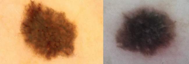 po lewej stronie znamię dysplastyczne, po prawej stronie czerniak po lewej stronie znamię dysplastyczne, po prawej stronie czerniak