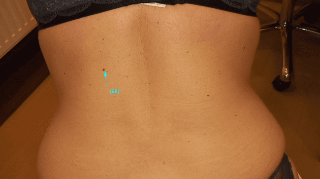 Zwykłe znamię barwnikowe - pieprzyk łagodny zdjęcie kliniczne Zwykłe znamię barwnikowe - pieprzyk łagodny zdjęcie kliniczne