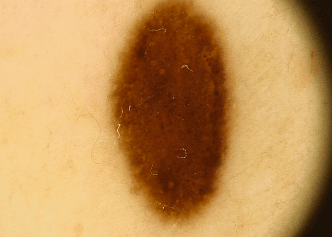 Wideodermatoskopia - zmapowane znamię nr 40. Wideodermatoskopia - zmapowane znamię nr 40.