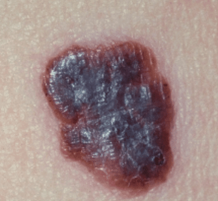 Czerniak złośliwy - melanoma może wyglądać jak naderwany pieprzyk Czerniak złośliwy - melanoma może wyglądać jak naderwany pieprzyk