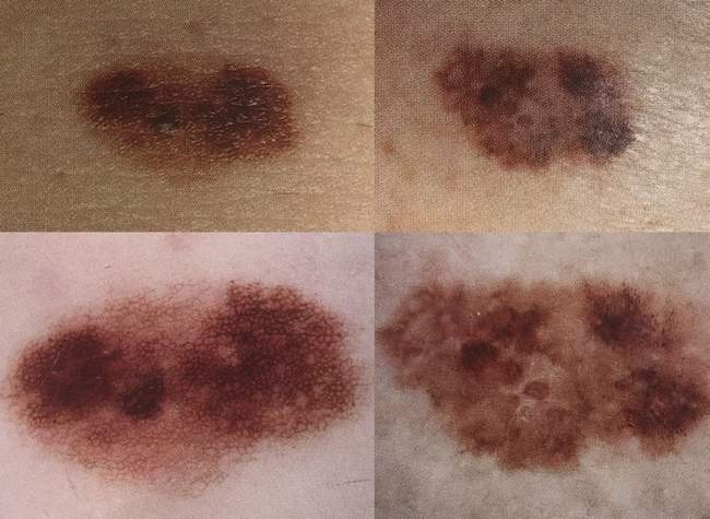 po lewej stronie znamię, po prawej stronie czerniak po lewej stronie znamię, po prawej stronie czerniak