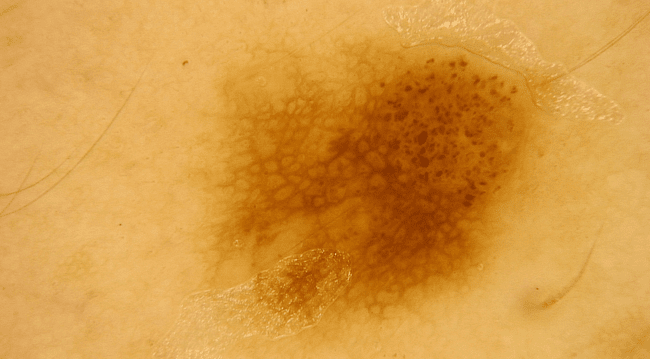 Zwykłe znamię barwnikowe - typowy pieprzyk zdjęcie dermatologiczne Zwykłe znamię barwnikowe - typowy pieprzyk zdjęcie dermatologiczne