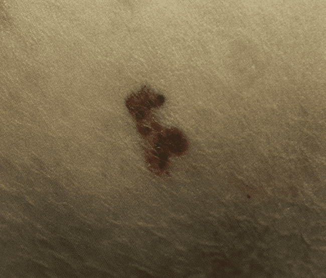 Czerniak złośliwy - melanoma wczesna postać zdjęcie dermatologiczne ABCDE Czerniak złośliwy - melanoma wczesna postać zdjęcie dermatologiczne ABCDE