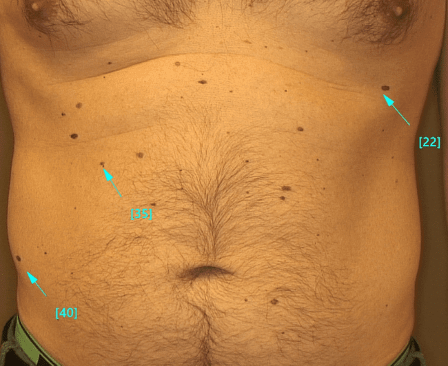 Wideodermatoskopia - mapowanie znamion. Wideodermatoskopia - mapowanie znamion.