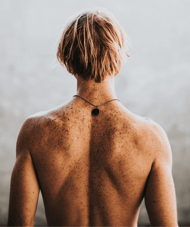 zespół znamion dysplastycznych - atypowych zespół znamion dysplastycznych - atypowych