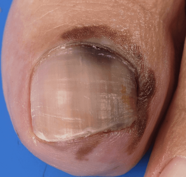 czerniak akralny czerniak akralny