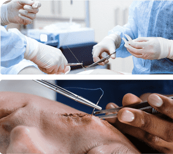 Chirurgiczne usuwanie znamion