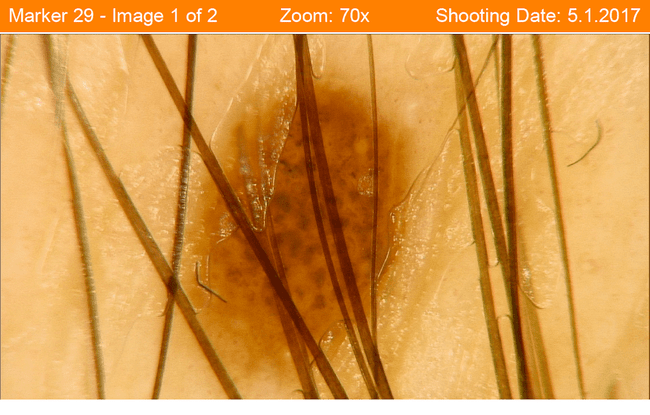 obraz dermatoskopowy znamienia w okolicy pokrytej włosami obraz dermatoskopowy znamienia w okolicy pokrytej włosami