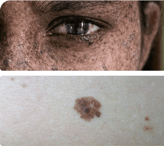 Dermatoskopowe badanie znamion Dermatoskopowe badanie znamion