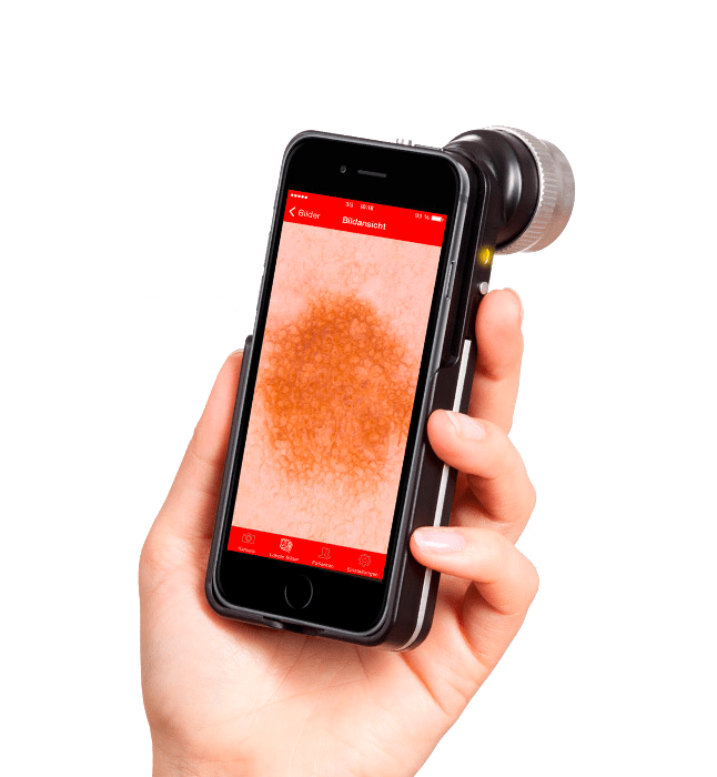 Dermatoskop ręczny Handysope, powiększenie do 20 x, nakładka współpracuje z iPhonem oraz Ipodem Touch Dermatoskop ręczny Handysope, powiększenie do 20 x, nakładka współpracuje z iPhonem oraz Ipodem Touch