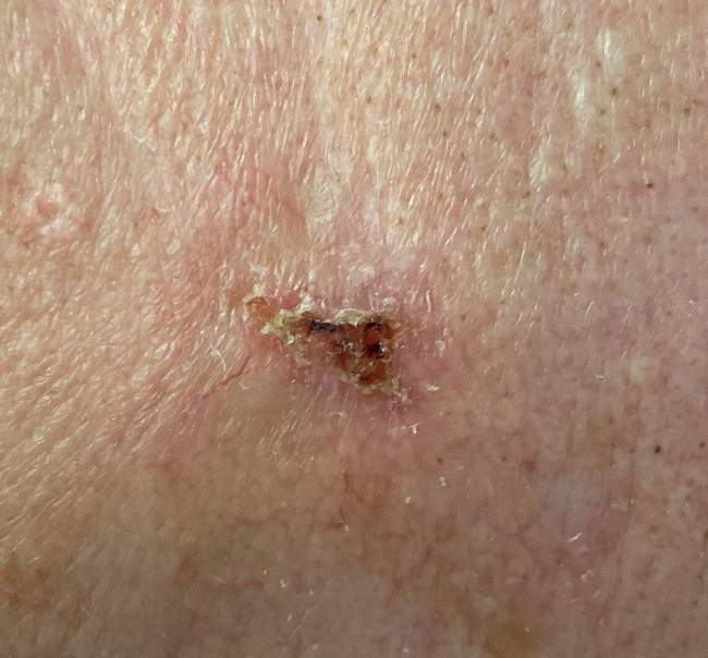 Rak podstawnokomórkowy — zdjęcie kliniczne