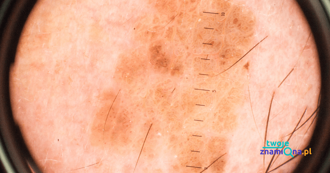 obraz dermatoskopowy obraz dermatoskopowy