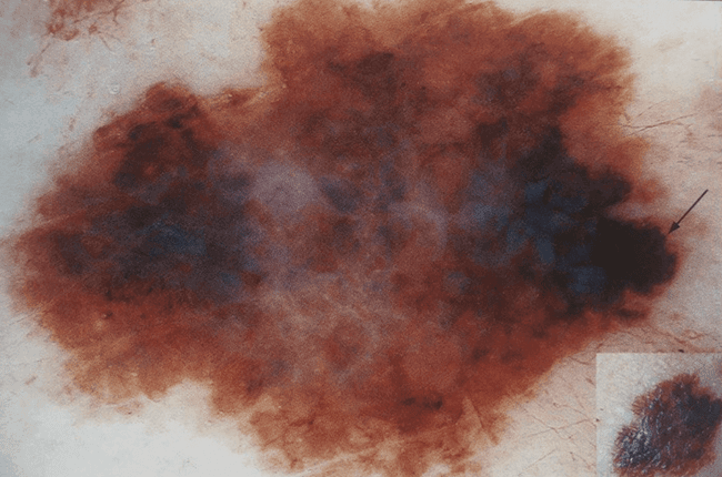 czerniak szerzący się powierzchownie SSM czerniak szerzący się powierzchownie SSM