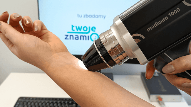 Badanie znamion wideodermatoskopem