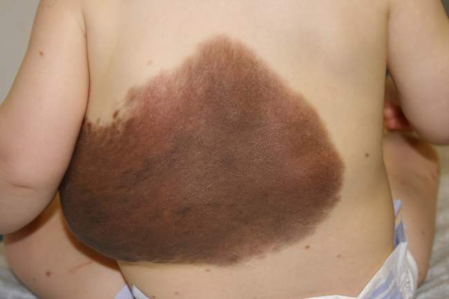 Olbrzymie znamię wrodzone u dziecka