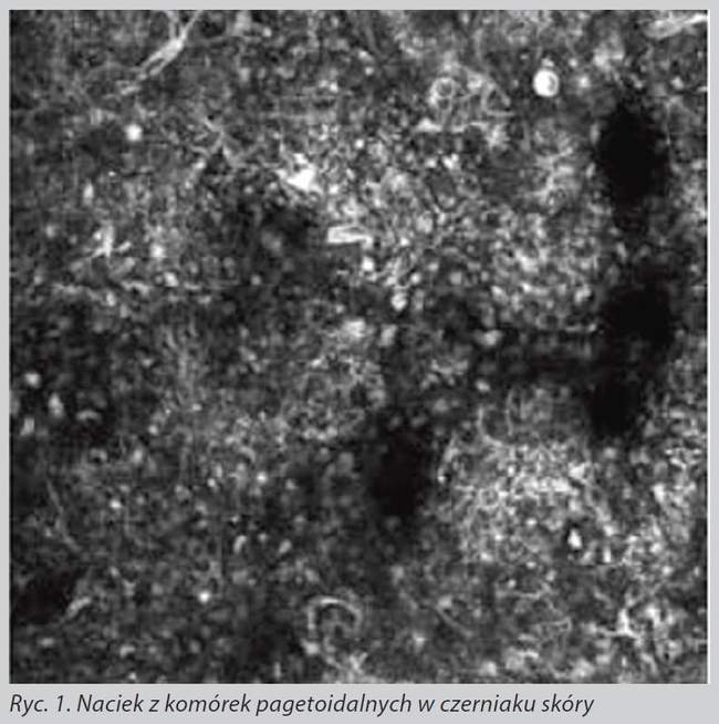 diagnostyka czerniaka skóry z wykorzystaniem refleksyjnej mikroskopii konfokalnej diagnostyka czerniaka skóry z wykorzystaniem refleksyjnej mikroskopii konfokalnej