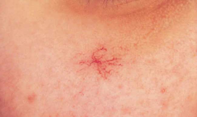 Naczyniak gwiaździsty