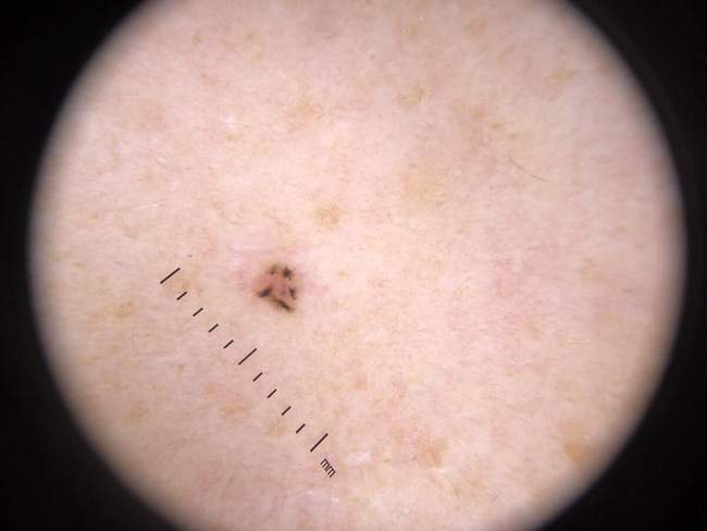 Rak podstawnokomórkowy — obraz dermatoskopowy