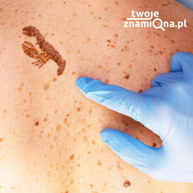 Badanie znamion Badanie znamion