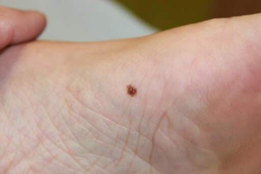 Czerniak akralny pod stopą