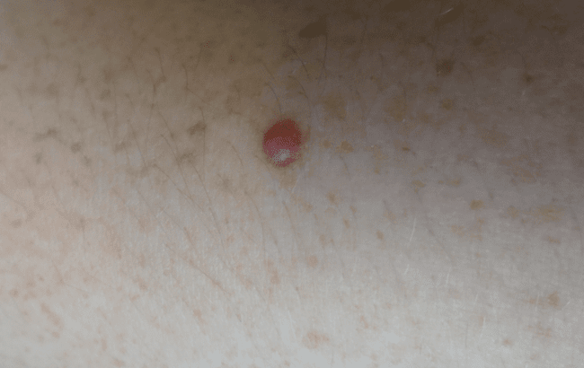 Czerniak bezbarwnikowy Czerniak bezbarwnikowy