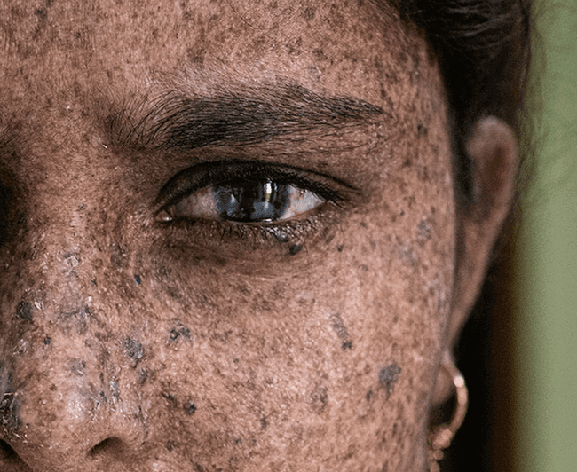 zespół znamion dysplastycznych - atypowych zespół znamion dysplastycznych - atypowych