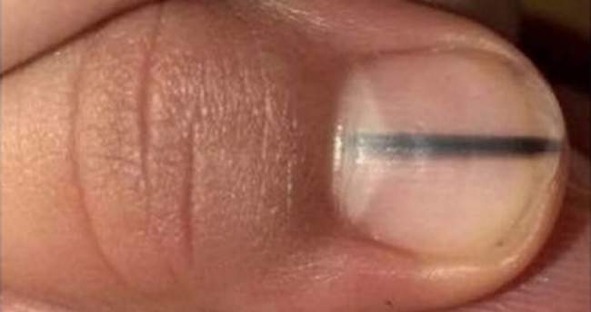 Czerniak podpaznokciowy - subungual melanoma zdjęcie kliniczne paznokieć