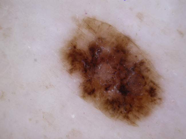 Czerniak skóry - melanoma wczesny czerniak zdjęcie kliniczne