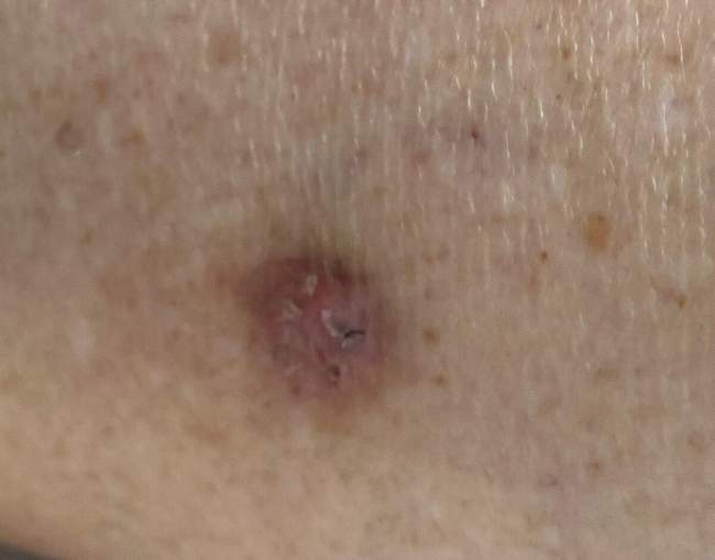 Rak podstawnokomórkowy — zdjęcie kliniczne