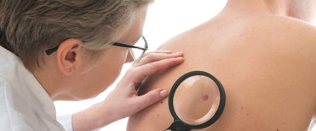 badanie pieprzyków i znamion