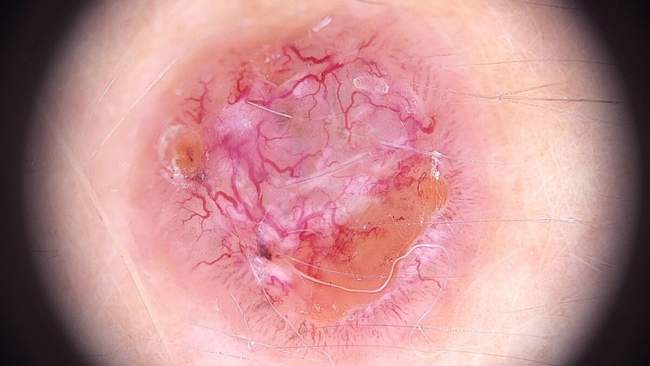 Rak podstawnokomórkowy — obraz dermatoskopowy