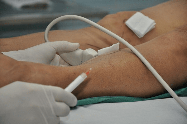 BACC - biopsja aspiracyjna cienkoigłowa celowana - biopsja, którą wspomaga USG BACC - biopsja aspiracyjna cienkoigłowa celowana - biopsja, którą wspomaga USG