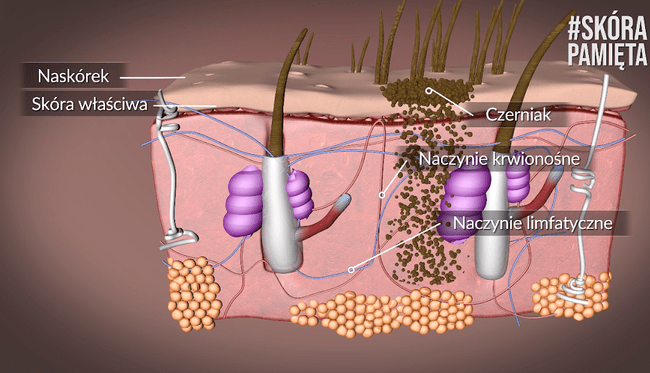 Czerniak pokonuje kolejne warstwy skóry. Czerniak pokonuje kolejne warstwy skóry.