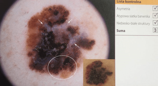 Czerniak złośliwy - ocena na podstawie 3-punktowej skali dermoskopowej.  Czerniak złośliwy - ocena na podstawie 3-punktowej skali dermoskopowej. (Dermatoskopia - H.P. Soyer; G. Argenziano; R. Hofmann-Wallenhof; I. Zalaudek)