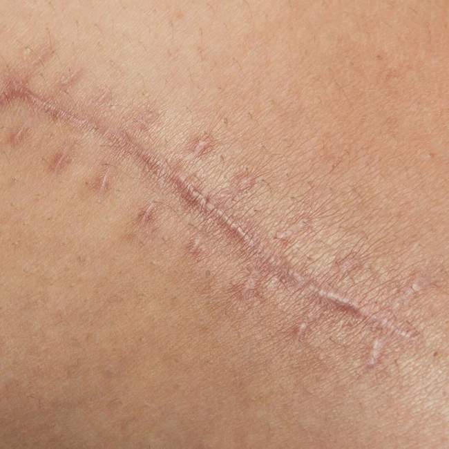 Blizna po zabiegu — zdjęcie kliniczne