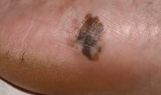 czerniak akralny czerniak akralny